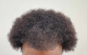 greffe cheveux afro