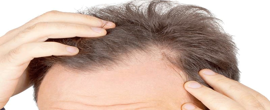 FAQ greffe cheveux