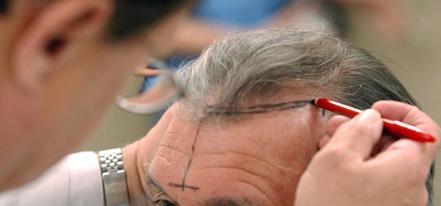 Greffe de cheveux hommes