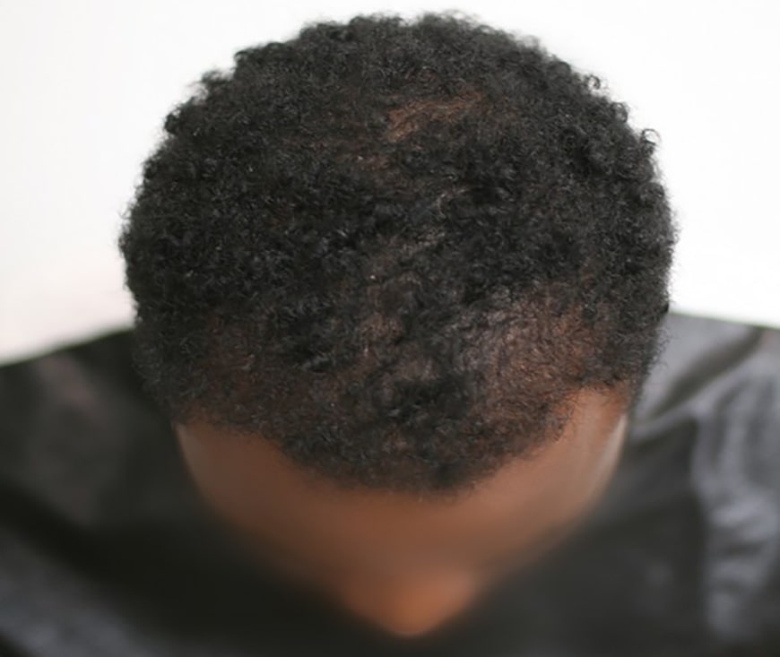greffe cheveux crepus