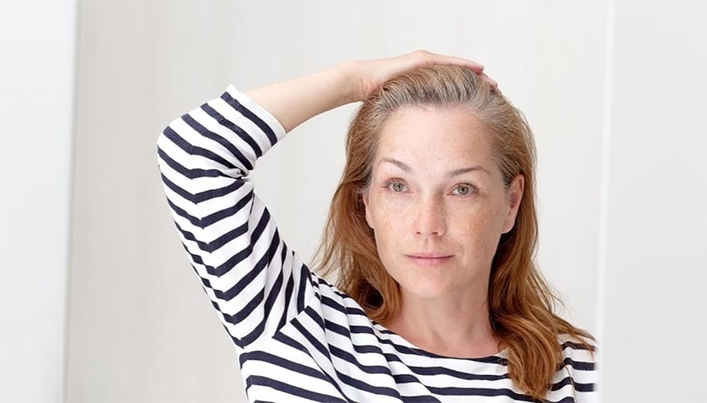 Greffe de Cheveux : L'Art de Recréer une Ligne Frontale Naturelle