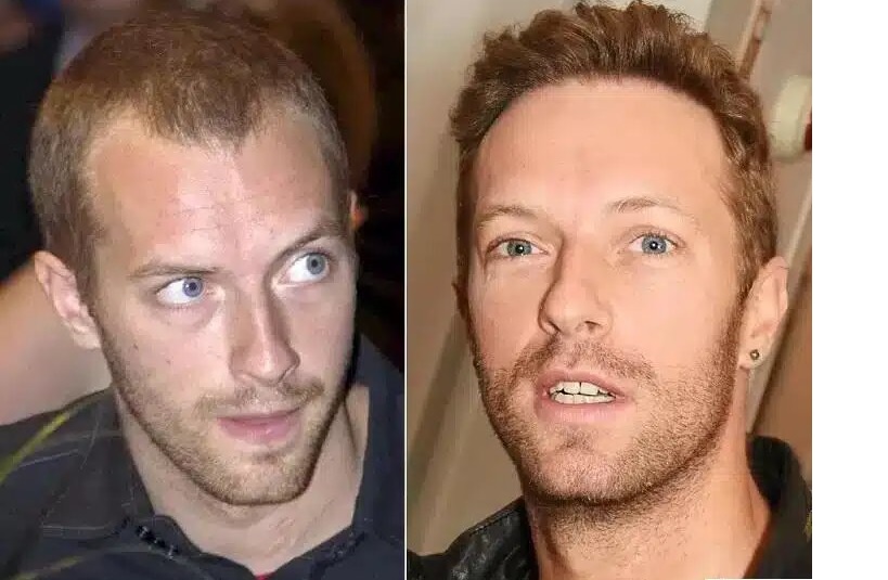 Chris Martin avant apres