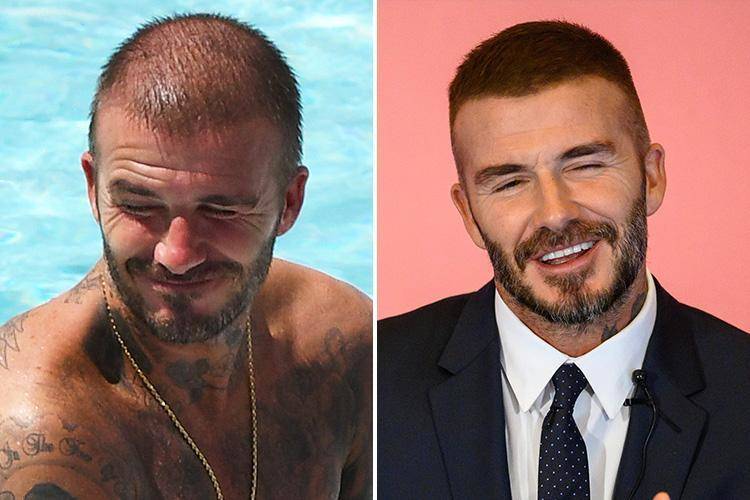 David Beckham avant apres greffe cheveux