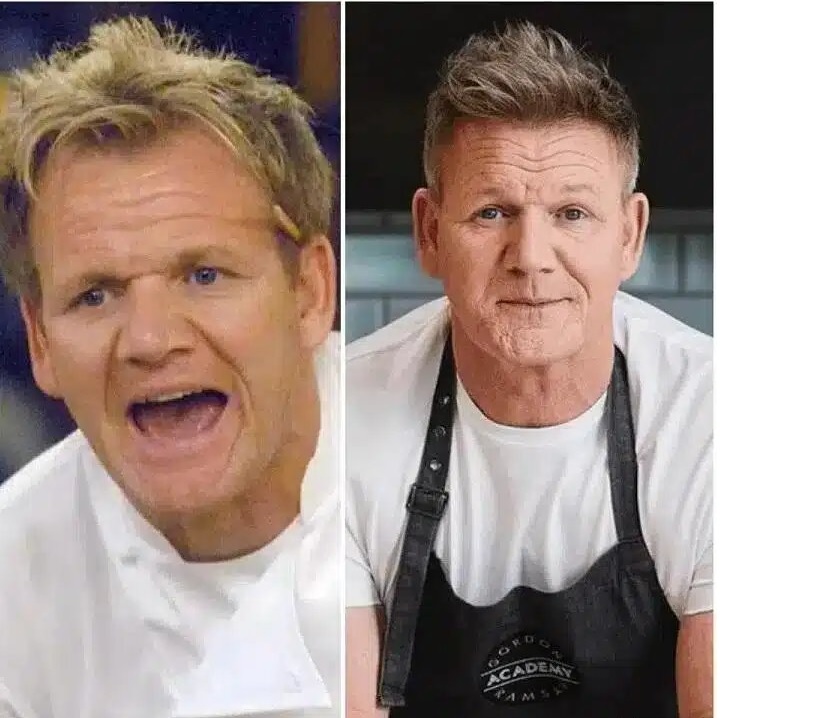 Gordon-Ramsay greffe de cheveux