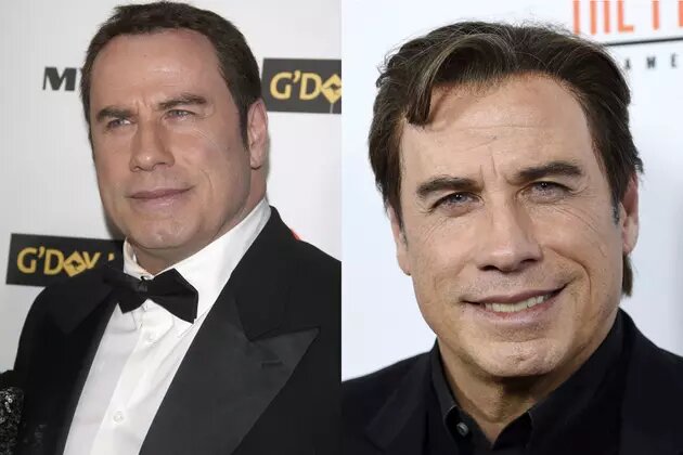 john travolta greffe de cheveux