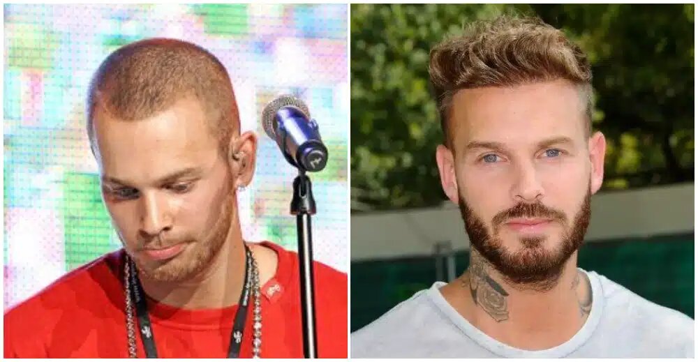 Matt Pokora greffe cheveux