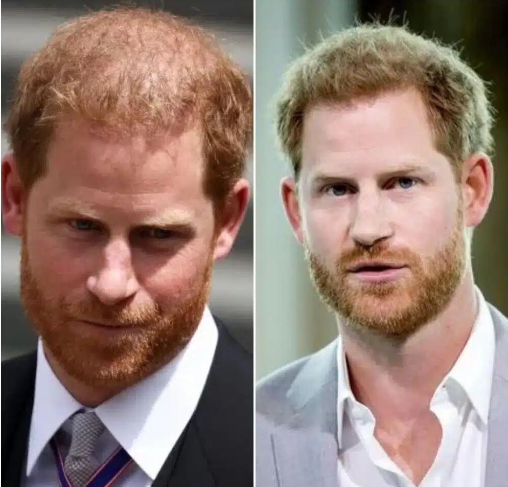 Prince harry greffe de cheveux avant apres