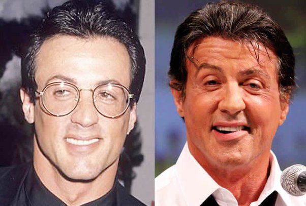 Sylvester Stallone greffe de cheveux