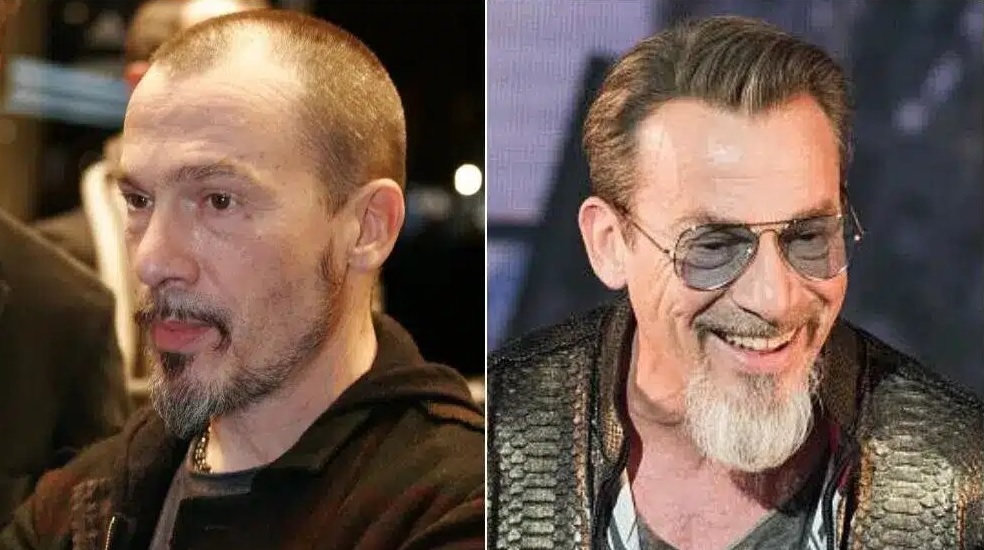 Florent pagny avant apres