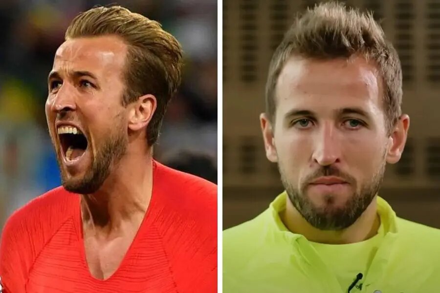 Harry Kane greffe cheveux