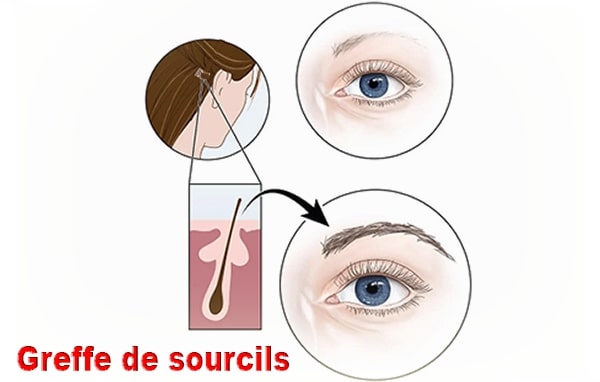 greffe des sourcils