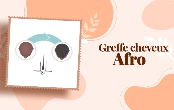 Greffe de cheveux afro