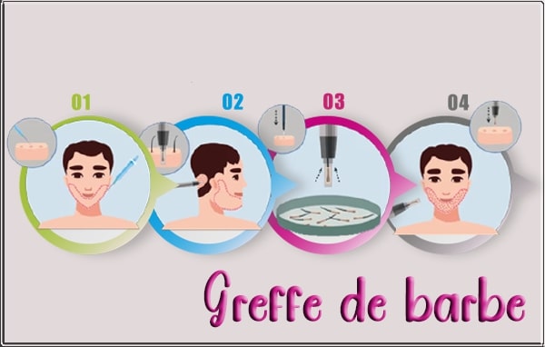 greffe de barbe