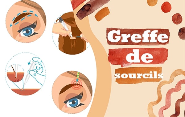 Greffe de Sourcils